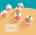 Illustration of traditional Chinese medicine therapy. cupping therapy, a treatment used to relieve pain and other health benefits. Royalty Free Stock Photo