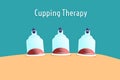 Illustration of traditional Chinese medicine therapy. cupping therapy, a treatment used to relieve pain and other health benefits. Royalty Free Stock Photo