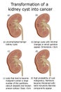 Illustration of transformation of a kidney cyst into cancer