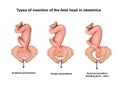 Types of insertion of the fetal head in obstetrics Royalty Free Stock Photo