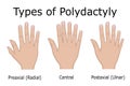 Illustration of Types of Polydactyly Royalty Free Stock Photo