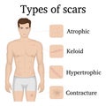 Illustration of the types of scars Royalty Free Stock Photo