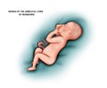 umbilical cord hernia in newborns