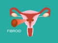 Illustration of the uterine fibroid. Intramural myoma