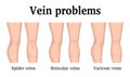 Illustration of vein problems Royalty Free Stock Photo