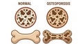 Normal vs. Osteoporosis Bone Comparison Royalty Free Stock Photo