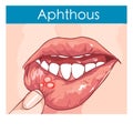 Illustration of a Woman with aphthae on lip Royalty Free Stock Photo