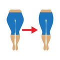 Fat and slim womans hip. Illustration of a woman with cellulite