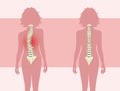 Woman with scoliosis problem