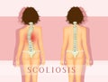 Woman with scoliosis problem