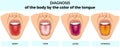 Illustrationn of the different colors of a tongue with inscriptions