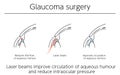 Illustrations, Glaucoma surgery, Medical Illustrations