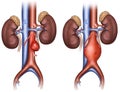 Imagen de aneurisma abdominal El aneurisma de aorta abdominal