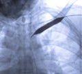 Image of Angioplasty, balloon angioplasty and percutaneous transluminal angioplasty (PTA Royalty Free Stock Photo