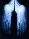 Foot xray Royalty Free Stock Photo