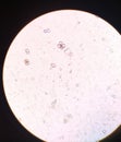 Calcium oxalate in urine microscopic