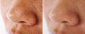 Before and after acne on nose treatment