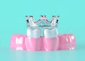 The image depicts an isolated dental crown and teeth installation set against a plain white background, created using 3D Royalty Free Stock Photo