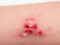 Skin with red pustules Royalty Free Stock Photo