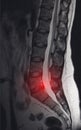 Image after examination of magnetic resonance imaging. Spine examination concept, otseochondrosis, lumbar intervertebral