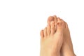 Image of feet with toenail affected with fungal infection, isolated image Royalty Free Stock Photo