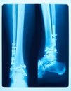 Image of film x-ray of human feet fracture front and side views, taken to see injuries of bones for a medical diagnosis