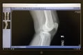 X-Ray of a healthy knee bone on a computer screen