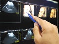 Soft and blurry image Hand doctor holdding a pen on image Ultrasound 3D/4D of baby in mother`s womb.