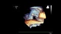 Image of the heart during transesophageal ultrasound.