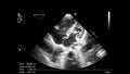 Image of the heart during transesophageal ultrasound.