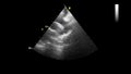 Image of the heart during transesophageal ultrasound.