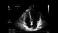 Image of the heart during transesophageal ultrasound.