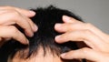 Man suffering from thinning hair Royalty Free Stock Photo
