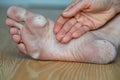Dry skin, plantar callosity and flakes on the female feet sole close up. Hand applying medicated ointment to heel