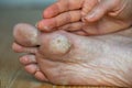 Dry skin, plantar callosity and flakes on the female feet sole close up. Hand applying medicated ointment to sole