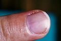 The image shows a finger with a visible, healing wound