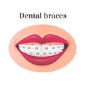 image of a smiling mouth with metal dental braces