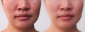 Image before and after spot melasma pigmentation facial treatment on face. Royalty Free Stock Photo