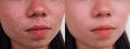 Image before and after spot red scar acne pimple treatment.