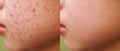 Image before and after spot scar acne pimple treatment on the face of young Asian woman. Problem skincare and beauty concept. Royalty Free Stock Photo