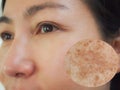 Image before and after treatment rejuvenation surgery on face asian woman concept. Closeup wrinkles dark spots pigmentation .