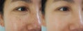 Image before and after treatment rejuvenation surgery on face asian woman concept. Closeup wrinkles dark spots pigmentation . Royalty Free Stock Photo