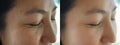 Image before and after treatment rejuvenation surgery on face asian woman concept. Closeup wrinkles dark spots pigmentation . Royalty Free Stock Photo