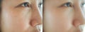 Image before and after treatment rejuvenation surgery on face asian woman concept. Closeup wrinkles dark spots pigmentation . Royalty Free Stock Photo