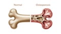 Normal Bone vs. Osteoporosis Bone Comparison Royalty Free Stock Photo