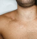 image of white spots on the skin of a man& x27;s chest due to fungus, pityriasis versicolor. Malassezzia furfur