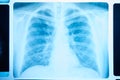 Image of x-ray film of human chest front view, taken to examine the lungs