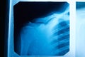 Image of x-ray film of human shoulder joint front view, taken to see injuries of tendons and bones for a medical diagnosis