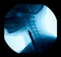 The image of x-ray upper gastrointestinal UGI, Esophagram. Royalty Free Stock Photo