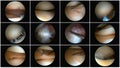 Images of an arthroscopy of the knee